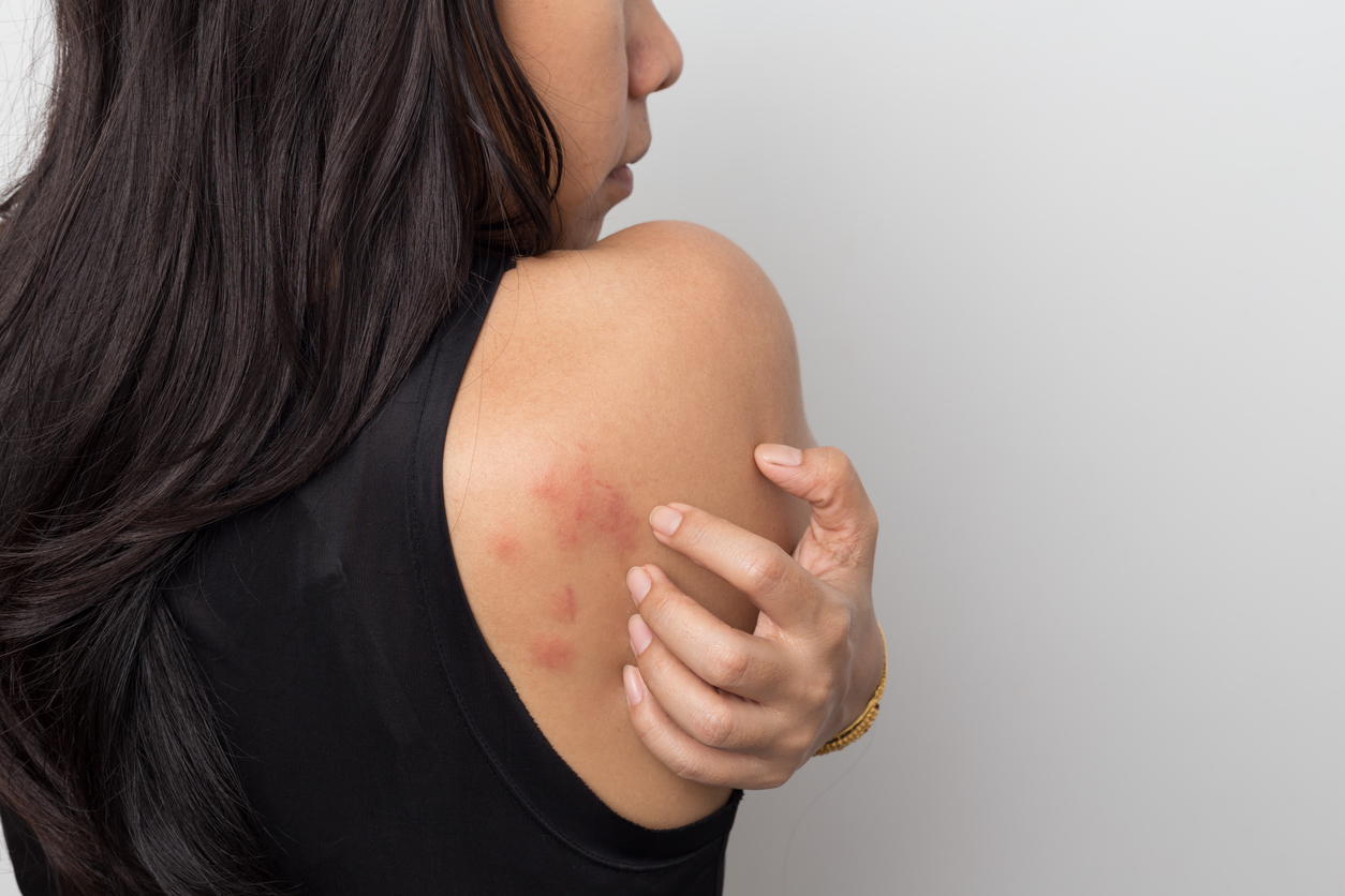 Chronic spontaneous urticaria after Long COVID | Treatment