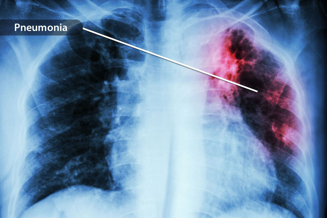 Infected with COVID-19 Will develop Pneumonia

