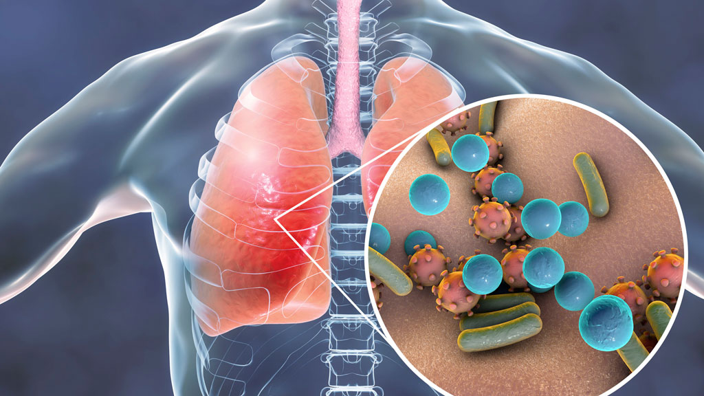 
Corona Virus infecting air sacs of lungs

