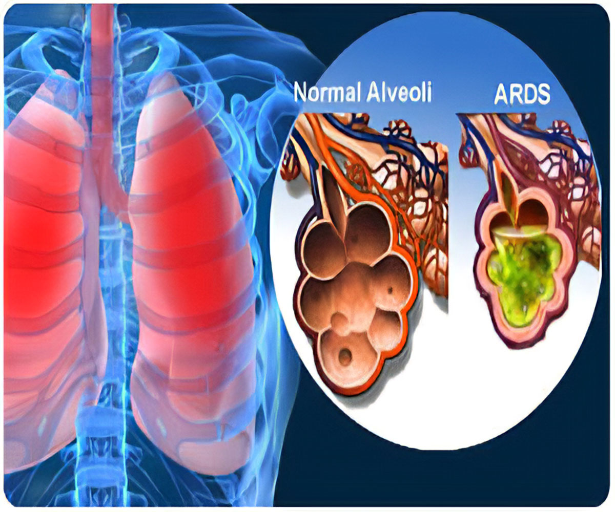 Acute Respiratory Distress Syndrome (ARDS