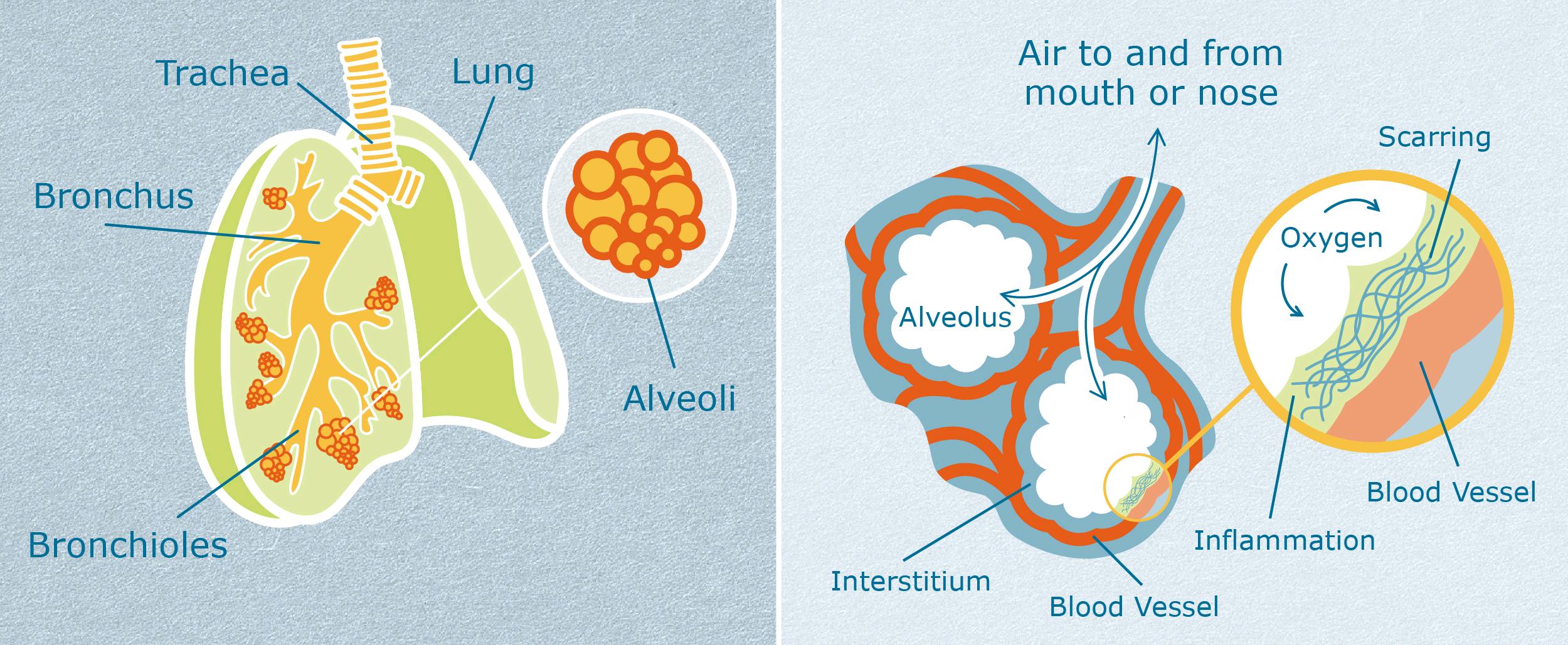 Effect Of Covid-19 And Its Vaccine On Interstitial Lung Disease