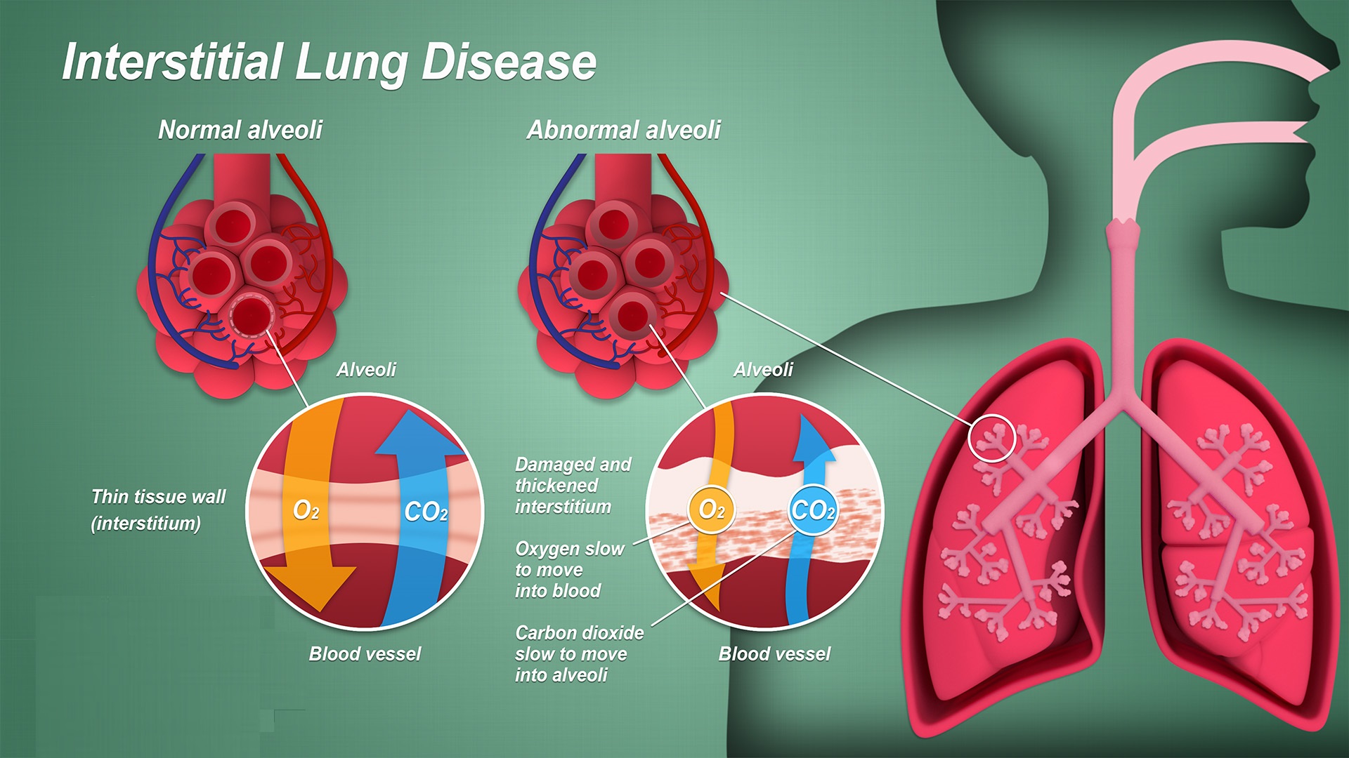 A rare reaction to COVID: Interstitial Lung Disease