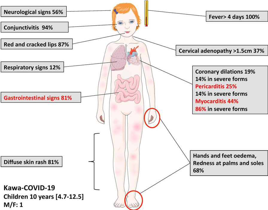 Multisystem Inflammatory Syndrome in Children caused due to Covid-19