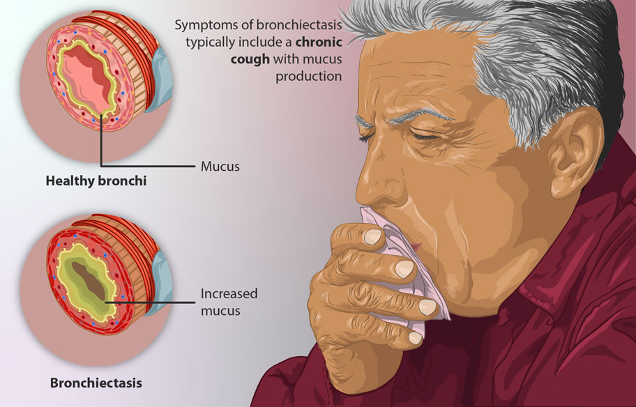 Symptoms of Bronchiectasis