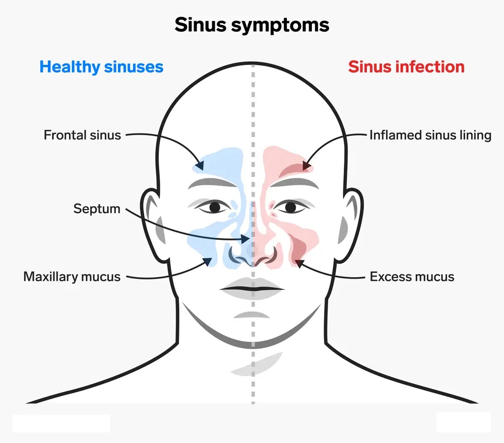 Symptoms of Sinus after Covid-19